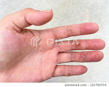 特應性皮炎患者因蕁麻疹加重而出現皮膚龜裂、手部濕疹、手粗糙 102760554