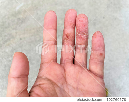 特應性皮炎患者因蕁麻疹加重而出現皮膚龜裂、手部濕疹、手粗糙 特應性皮炎患者因蕁麻疹加重而出現皮膚龜裂、手部濕疹、手粗糙 102760578