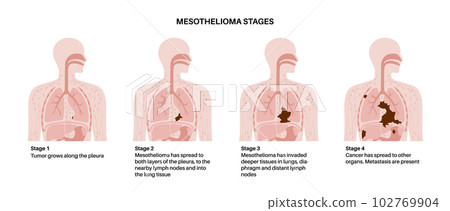 Mesothelioma cancer stages 102769904