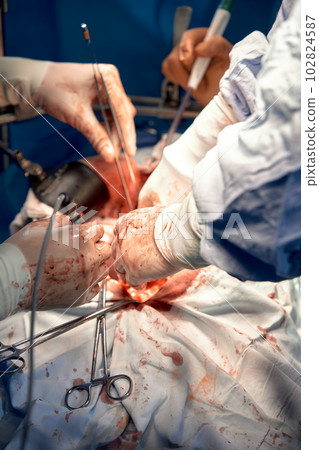 Group of surgeons in the operating room with surgical equipment. Close-up of hands holding surgical instruments. Surgical operation on the internal organs of a person. Real operation 102824587