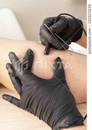 Dermatologist Doing Hair Removal Electrolysis Procedure On Woman's Leg, Shin. Electric Epilation In Beauty Salon. Vertical Plane. Authentic Photo 102825656