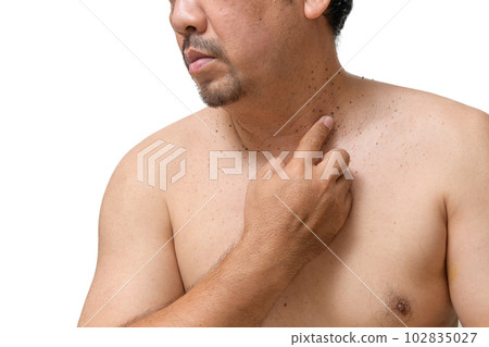 middle age senior man point to skin tags or acrochordon on his neck isolated on white background. middle age senior man point to skin tags or acrochordon on his neck isolated on white background. 102835027