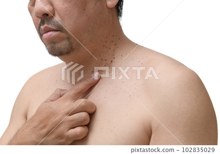 middle age senior man point to skin tags or acrochordon on his neck 102835029