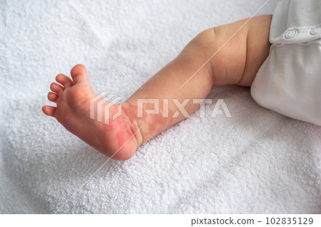 Hemangioma red birthmark on the leg of newborn baby 102835129