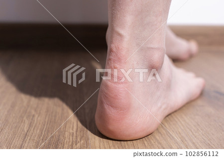 Closeup Allergic Contact Dermatitis On Foot, Ankle, Heel Caused By Direct Contact With Allergen. Red Itchy Burning Skin With Flaky Patches And Blisters, Copy Space For Text. Horizontal Plane Closeup Allergic Contact Dermatitis On Foot, Ankle, Heel Caused By Direct Contact With Allergen. Red Itchy Burning Skin With Flaky Patches And Blisters, Copy Space For Text. Horizontal Plane 102856112