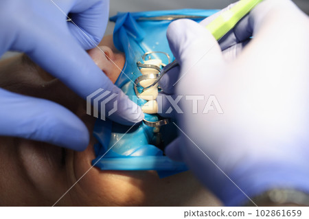 Doctor dentist fixing veneer on patient teeth using metal tools closeup Doctor dentist fixing veneer on patient teeth using metal tools closeup 102861659