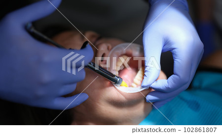 Dentist doctor applying adhesive for veneers and prosthetics in clinic closeup 102861807