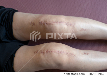 Scar on a woman's leg after knee replacement surgery Scar on a woman's leg after knee replacement surgery 102861962