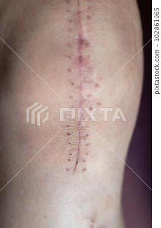 膝關節置換手術後女性腿上的疤痕 膝關節置換手術後女性腿上的疤痕 102861965