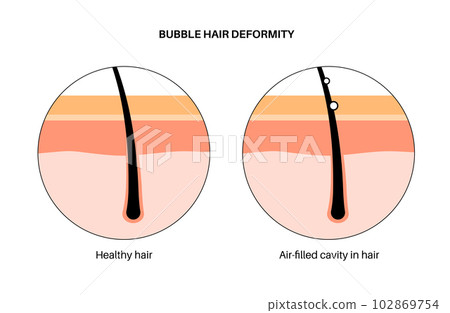 Bubble hair deformity 102869754