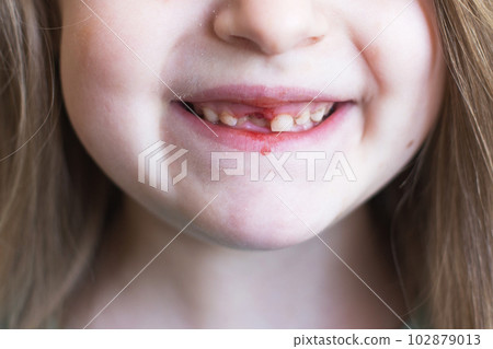 A little cute girl lost her front baby milk tooth. Lost temporary tooth. A little cute girl lost her front baby milk tooth. Lost temporary tooth. 102879013