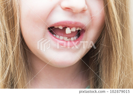 portrait of a little child girl moving her milk front tooth with her tongue in open mouth. portrait of a little child girl moving her milk front tooth with her tongue in open mouth. 102879015