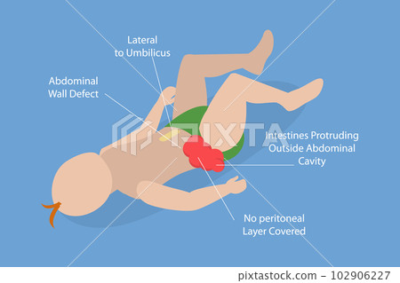 3D Isometric Flat Vector Conceptual Illustration of Gastroschisis 102906227