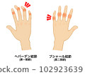 hand joint disease 102923639
