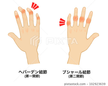 hand joint disease 102923639