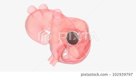 The damaged aortic valve may also be replaced with a mechanical or a biological tissue valve. 102939797