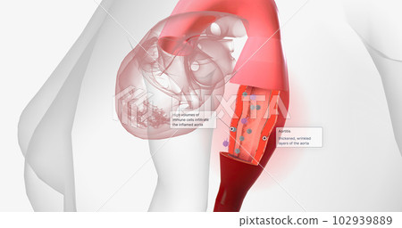 High volumes of lymphocytes, macrophages, and other immune cells infiltrate the inflamed aorta. 102939889