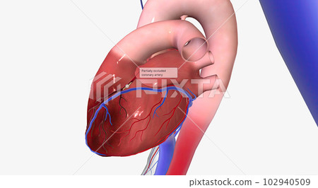 Angina is chest pain or discomfort due to reduced blood flow to the heart. Angina is chest pain or discomfort due to reduced blood flow to the heart. 102940509