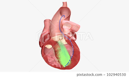 Alcohol causes enlarged heart muscle walls to shrink 102940530
