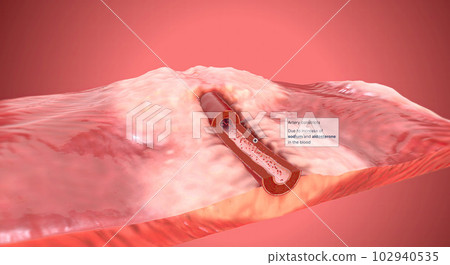 Due to increase of sodium and aldosterone in the blood artery constrict Due to increase of sodium and aldosterone in the blood artery constrict 102940535