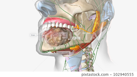 Once a tumor has spread into nearby lymph nodes, it is considered a stage three cancer. Once a tumor has spread into nearby lymph nodes, it is considered a stage three cancer. 102940555
