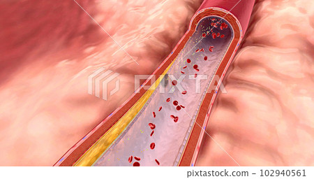 Atherosclerosis is the plaque buildup in the walls of the arteries. 102940561