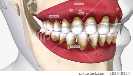 Periodontal disease occurs when all or some of the teeth and surrounding tissues are affected. 102940564