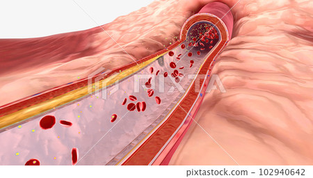 Atherosclerosis can sometimes narrow arteries that blood to the heart is restricted. 102940642