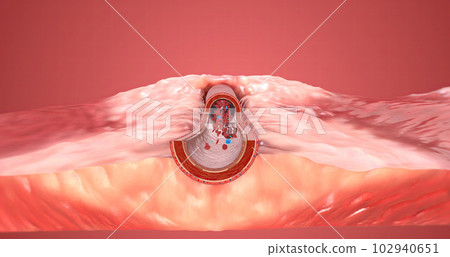 A blood clot is red blood cells that stick together in the bloodstream and are held in place by fibrin. 102940651