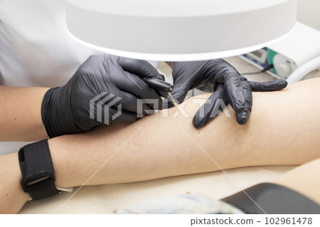 Hirsutism, Closeup Hair Removal Process With Electrolysis On Hand Of White Young Woman, Electric Epilation In Beauty Salon. Horizontal Plane. Authentic Photo Hirsutism, Closeup Hair Removal Process With Electrolysis On Hand Of White Young Woman, Electric Epilation In Beauty Salon. Horizontal Plane. Authentic Photo 102961478