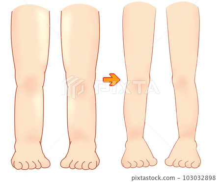 Swelling of the legs 103032898