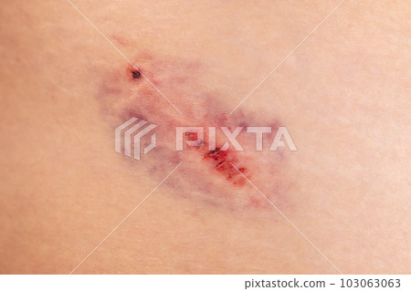 Closeup Bruise on wounded woman leg skin. Domestic violence 103063063