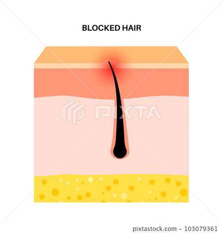 Ingrown hair inflammation Ingrown hair inflammation 103079361
