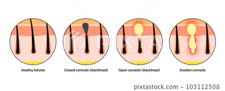 Acne treatment poster 103112508