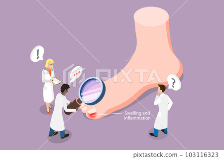3D Isometric Flat Vector Conceptual Illustration of Ingrown Toenail 3D Isometric Flat Vector Conceptual Illustration of Ingrown Toenail 103116323