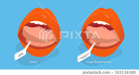 3D Isometric Flat Vector Conceptual Illustration of Ankyloglossia 3D Isometric Flat Vector Conceptual Illustration of Ankyloglossia 103116380
