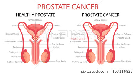 Prostate cancer. Male reproductive system. Anatomy of the internal organs of man. Infographic banner, chart, vector 103116823