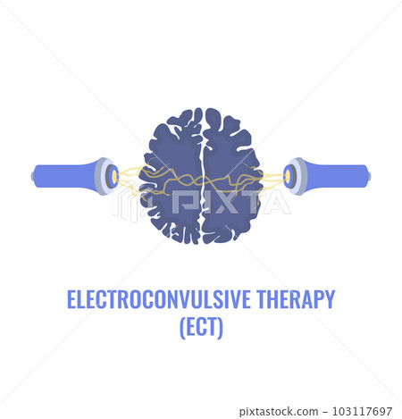 ECT electroconvulsive therapy for severe depression treatment 103117697