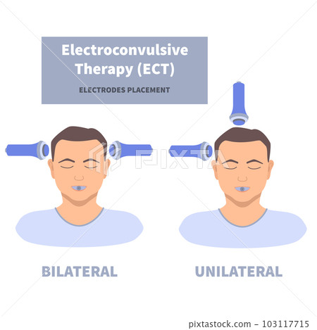 ECT electroconvulsive therapy for severe depression treatment 103117715