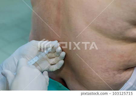 Doctor performs an epidural spinal anesthesia injections during prepare for surgery Doctor performs an epidural spinal anesthesia injections during prepare for surgery 103125715