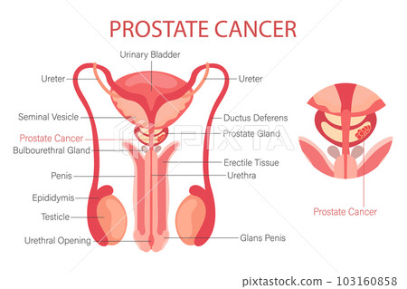 Prostate cancer. Male reproductive system. Anatomy of the internal organs of man. Infographic banner, diagram, vector 103160858