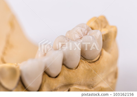 Denture made of ceramics Denture made of ceramics 103162156