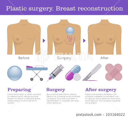 Plastic surgery breast reconstruction infographic Plastic surgery breast reconstruction infographic 103168022