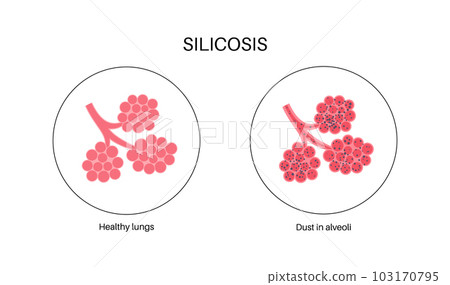 Silicosis dust in lung 103170795