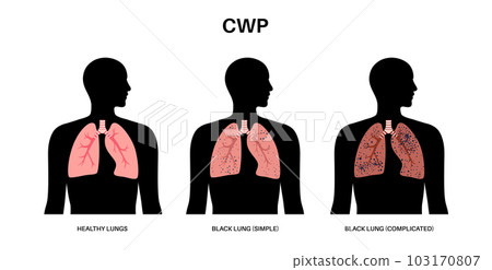 Coal workers disease Coal workers disease 103170807
