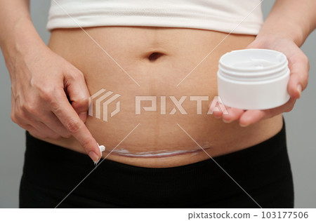 woman putting healing cream in c-section scar of cesarean woman putting healing cream in c-section scar of cesarean 103177506