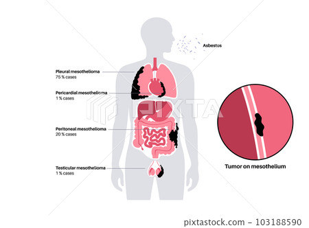 Mesothelioma tumor types Mesothelioma tumor types 103188590