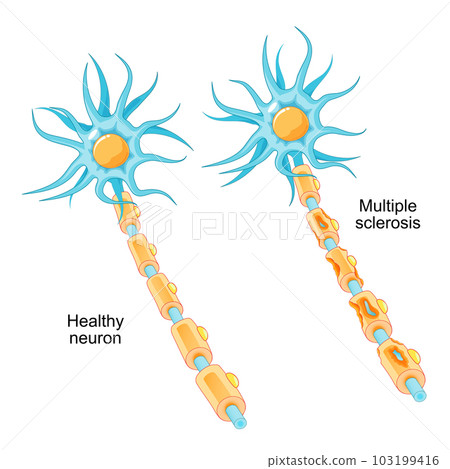 Multiple sclerosis. autoimmune disease 103199416