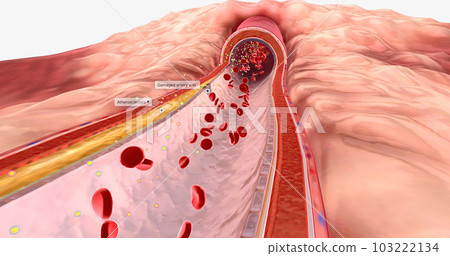 Atherosclerosis is the plaque buildup in the walls of the arteries. 103222134
