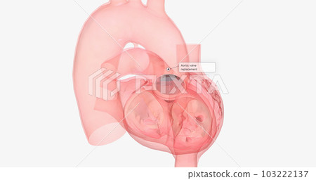 The damaged aortic valve may also be replaced with a mechanical or a biological tissue valve. The damaged aortic valve may also be replaced with a mechanical or a biological tissue valve. 103222137